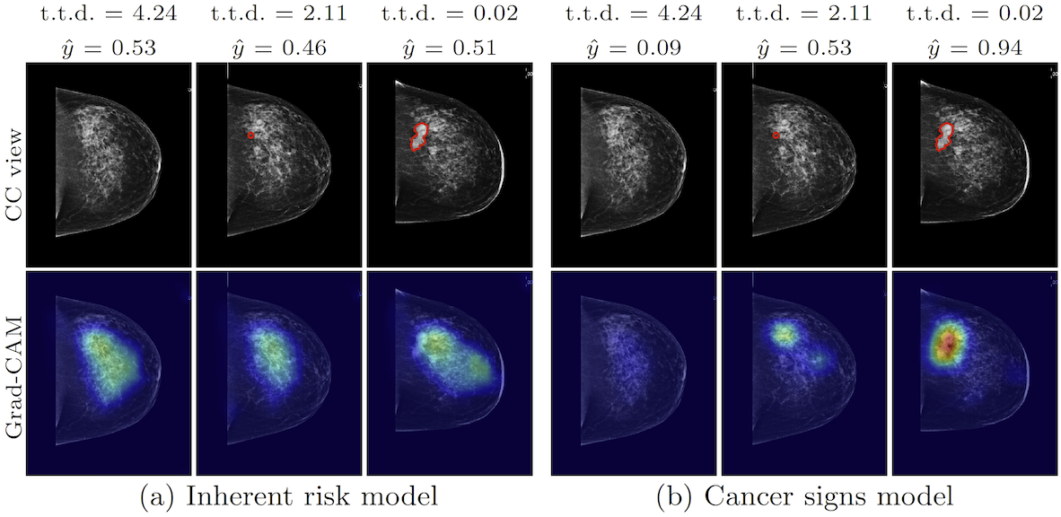Den översta raden (i svartvitt) visar mammografibilder med en framväxande tumör inritad (t.t.d.=tid till diagnos): 4,2 år före diagnos, 2,1 år före diagnos och vid diagnos. Den nedre raden (i blått) visar hur två olika AI-nätverk bedömt bilderna. De tre bilderna till vänster illustrerar ett AI-nätverk tränat på att upptäcka generell riskinformation (“Inherent risk model”), medan de tre bilderna till höger illustrerar ett annat AI-nätverk tränat på att upptäcka tumörförändringar (“Cancer sign")